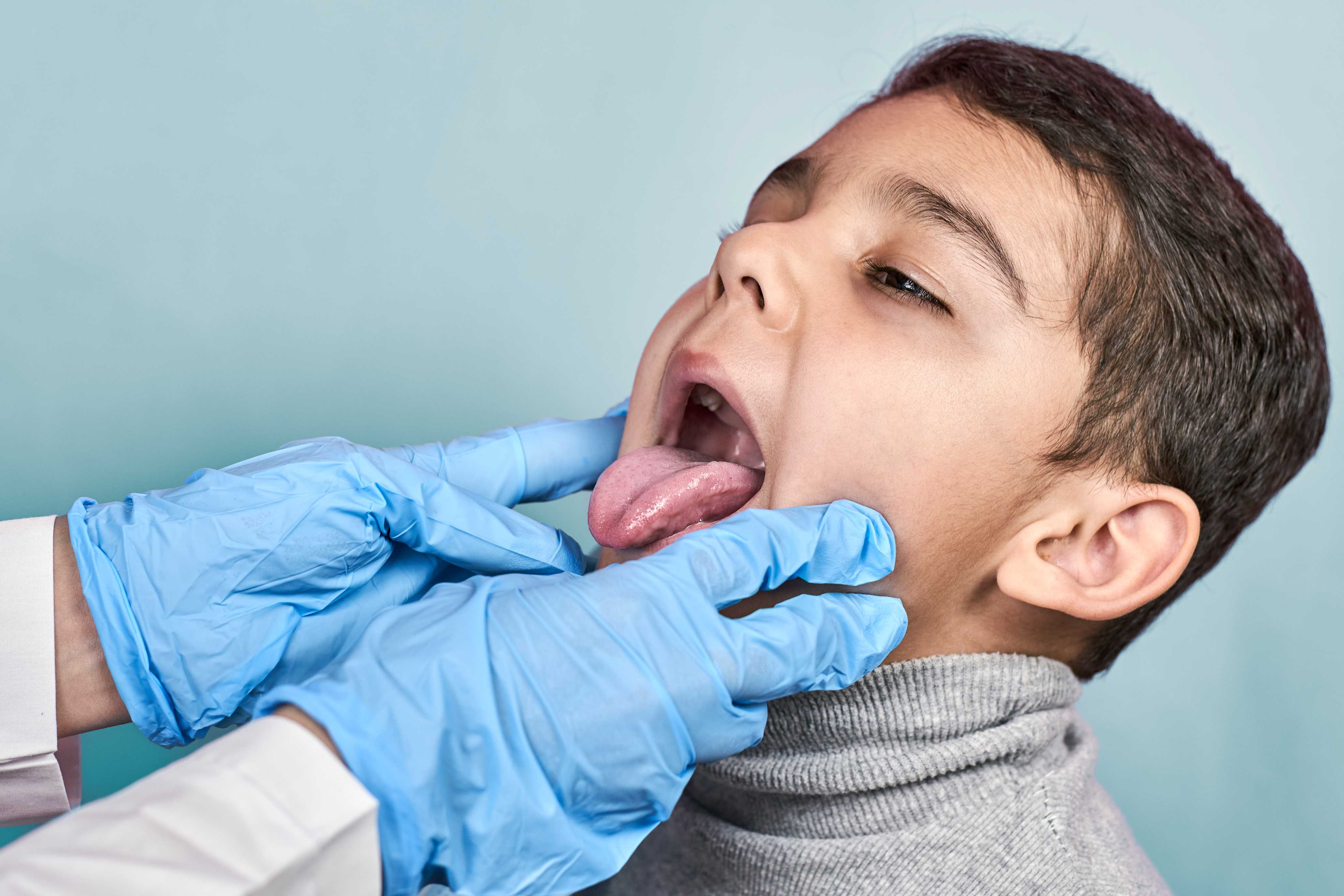 Free Cleft Lip & Palate Surgeries at Patel Hospital